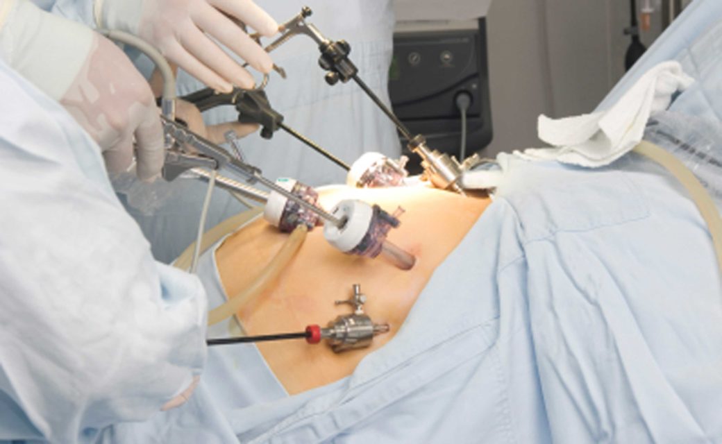 laparoscopic device development designed by Gm Design Development UK